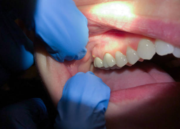 Best Emergency Denture Repair in Winter Beach, FL