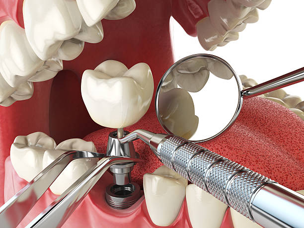 Best Emergency Treatment for Dental Infections or Abscesses in Winter Beach, FL